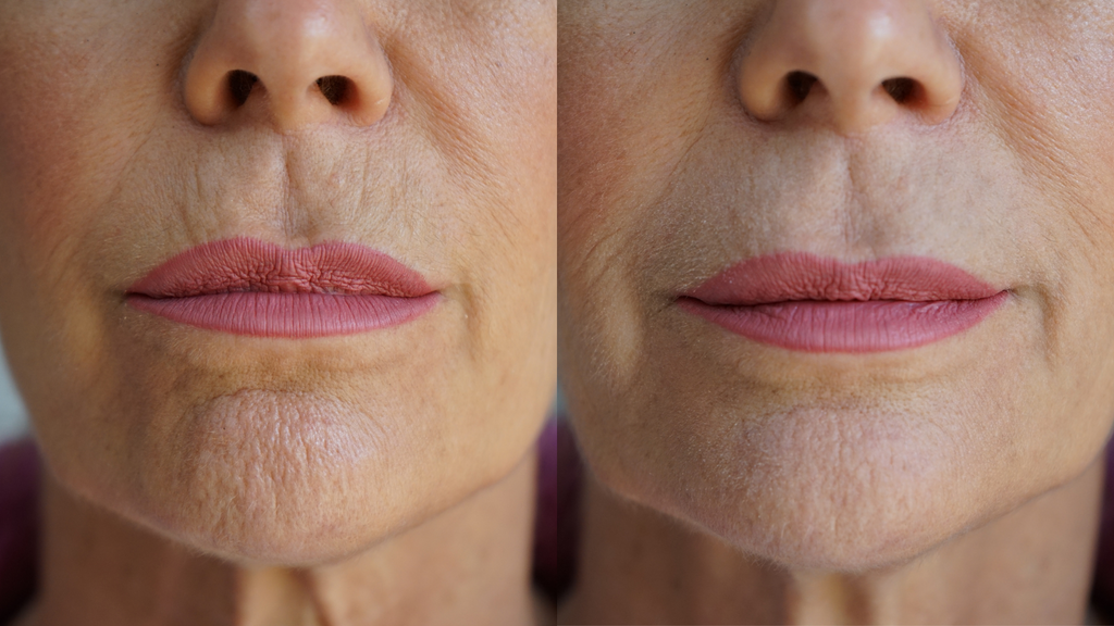 Ageless Lip & Line Filler